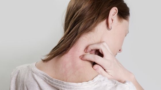 How to Differentiate between Psoriasis and Eczema