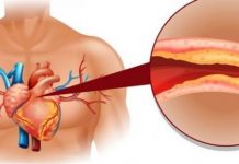 Symptoms of High Cholesterol What to Know about it