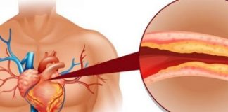 Symptoms of High Cholesterol What to Know about it