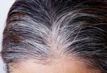 What Causes White Hair- Premature