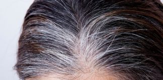 What Causes White Hair- Premature