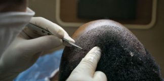 Success Rates of Different Types of Hair Transplants