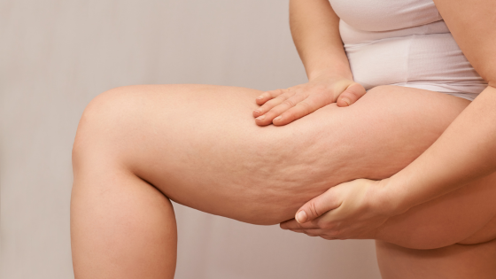 cellulite treatment
